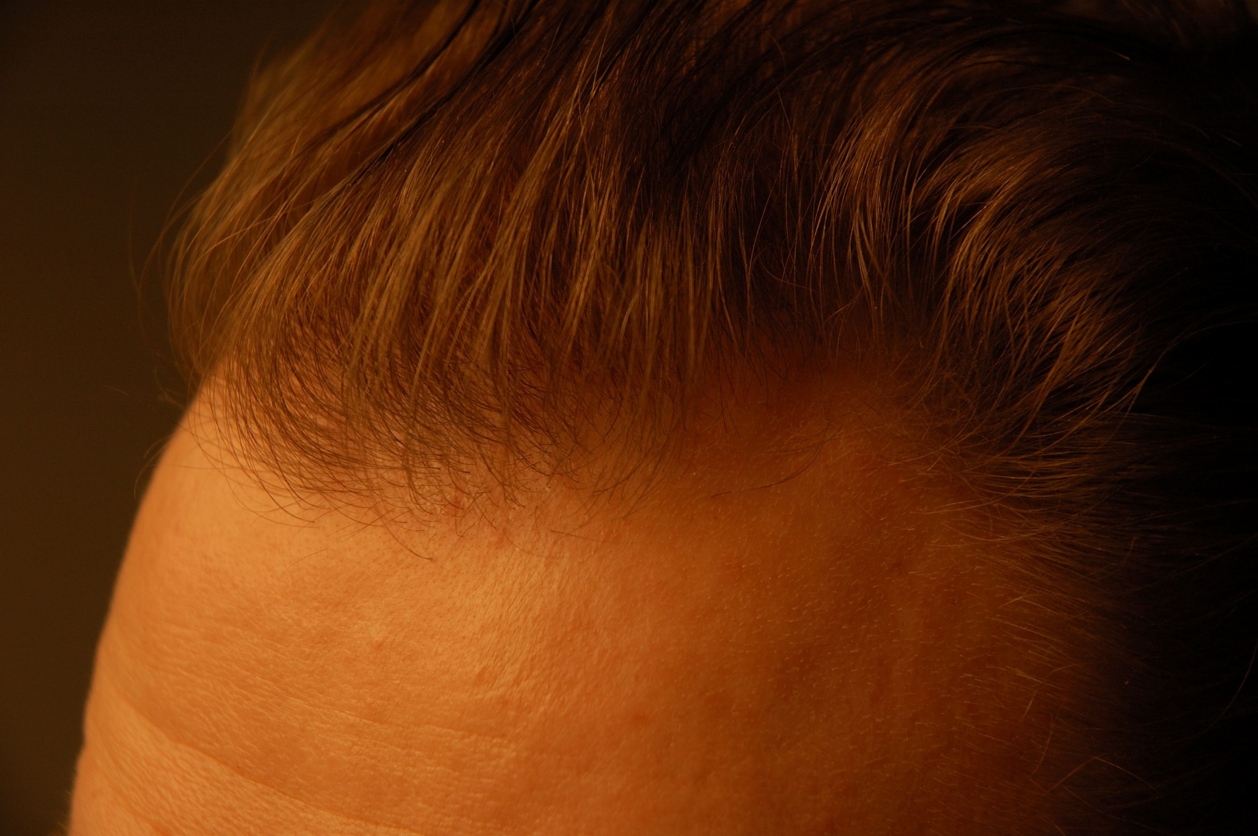 Fue hair transplant customer testimonial