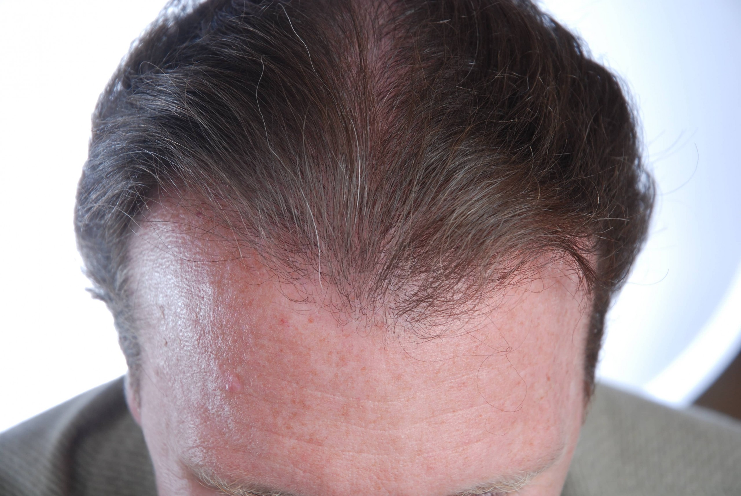 Fue hair transplant customer testimonial