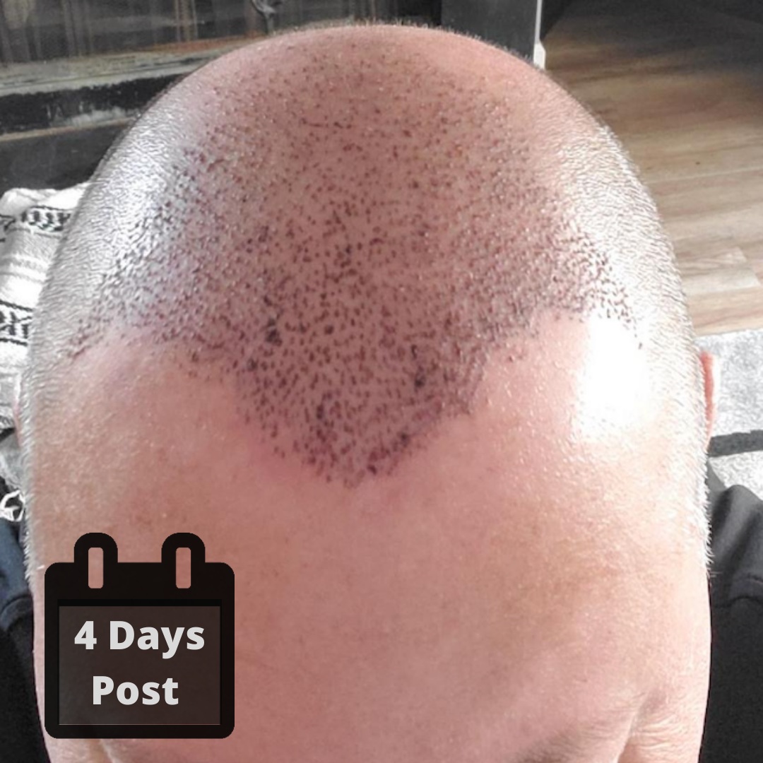 4 days post op