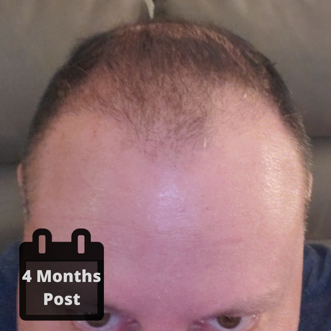 4 months post op