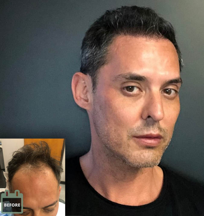 samson before-after fue hair transplant_1 before after hair transplant