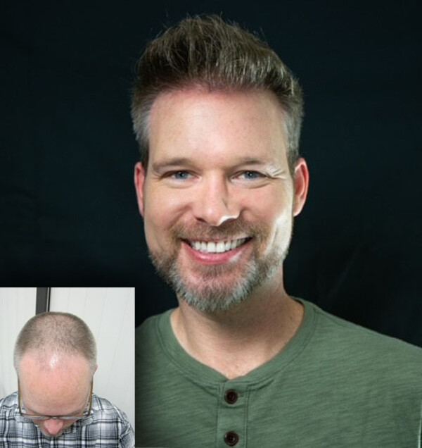 FUE Hair Transplant Experience Landing Samson Hair Restoration